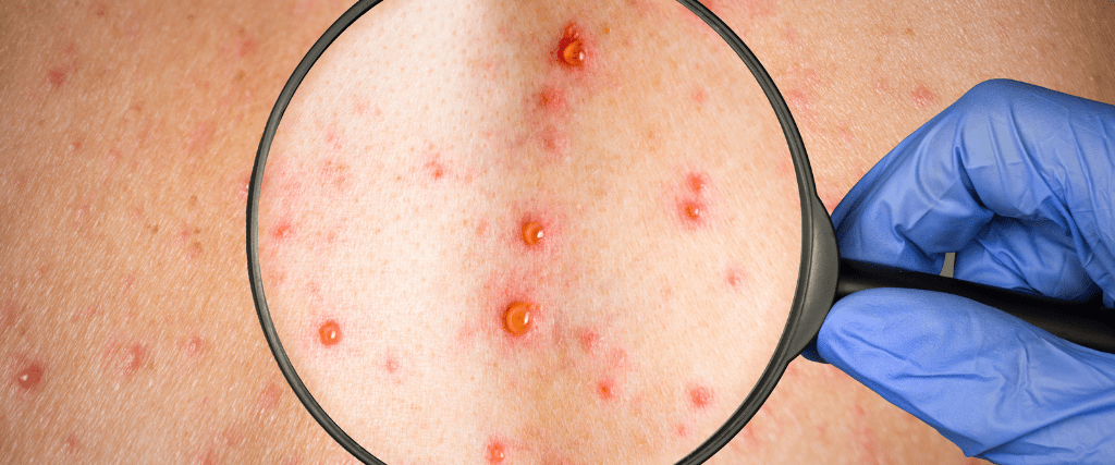 shingles vaccine north harrow