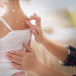 Creams & Itch Relief